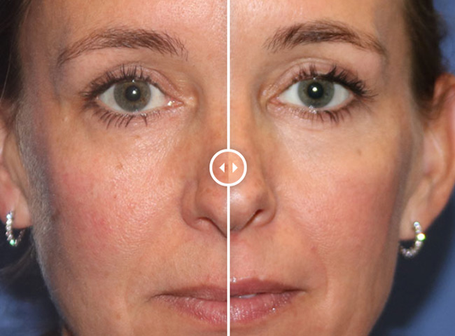 Voor en na Colorescience Pep Up collagen