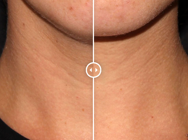 Colorescience Pep Up collagen voor en na